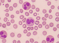 一种神秘颗粒被发明了！它能否成为败血症早筛标记物？？？？？？