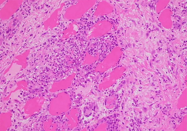 【BG大游助力】治疗结节病的KBMAB-16获FDA批准临床